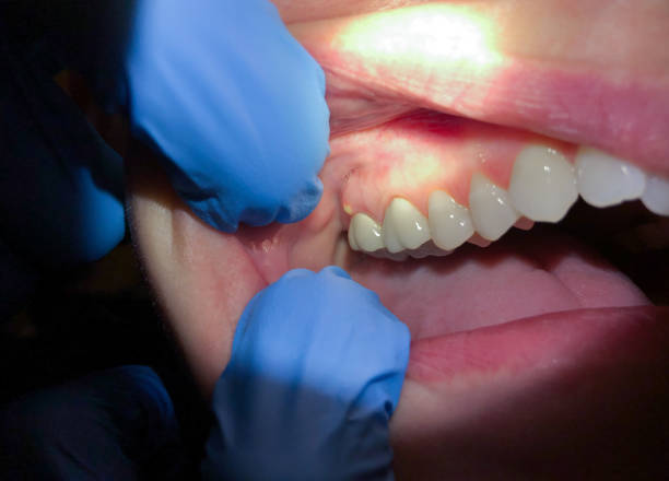 Best Cracked Tooth Emergency Dentist  in Uhrichsville, OH